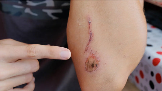 How to heal wounds faster naturally